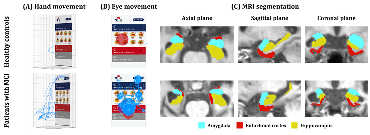 Hand movement, eye movement, and MRI segmentation comparison — healthy controls vs. patients with MCI